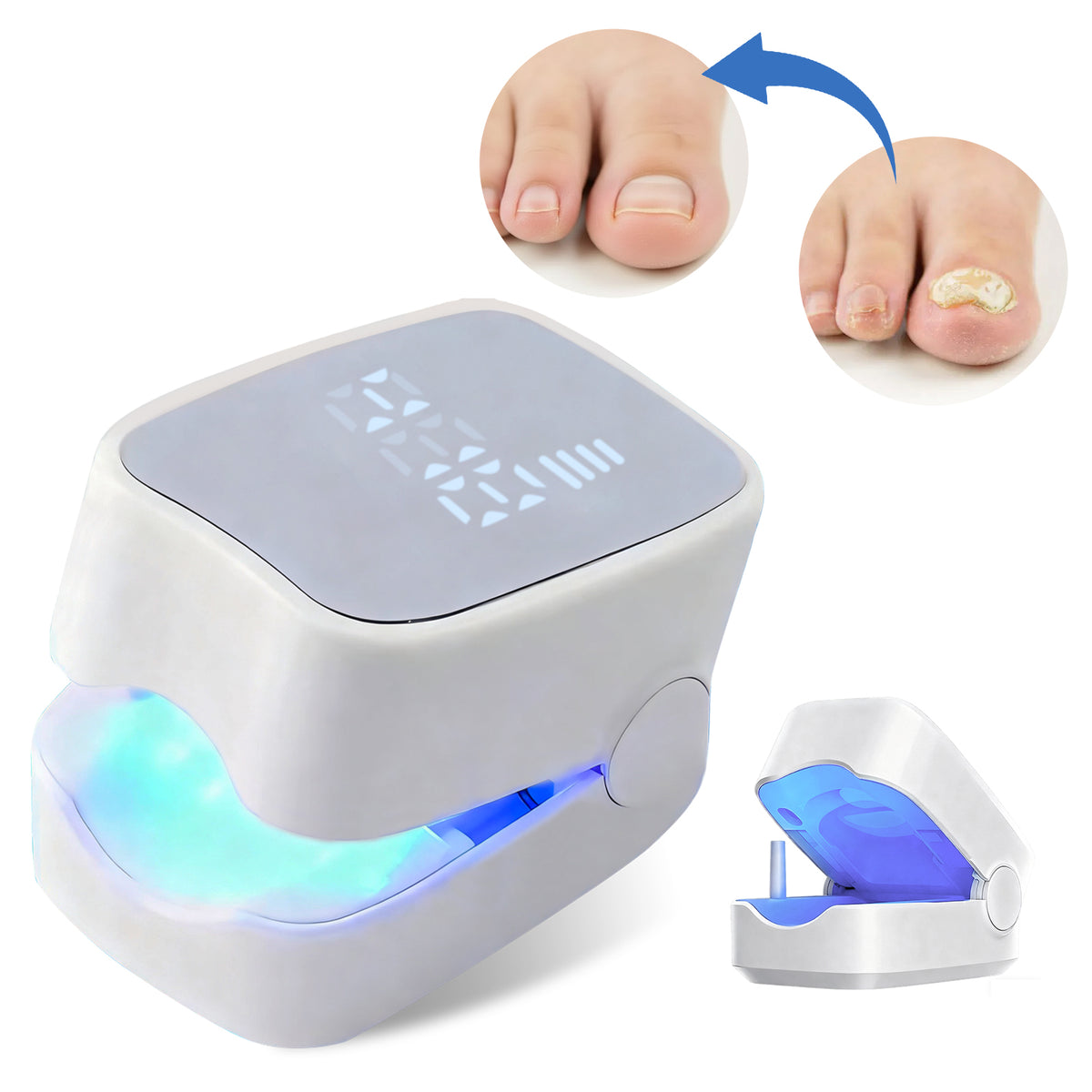 Nail Fungus Remover Laser Device For Damaged and Discolored Nails 940nm+500nm